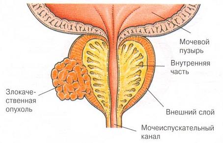 Рак предстательной железы
