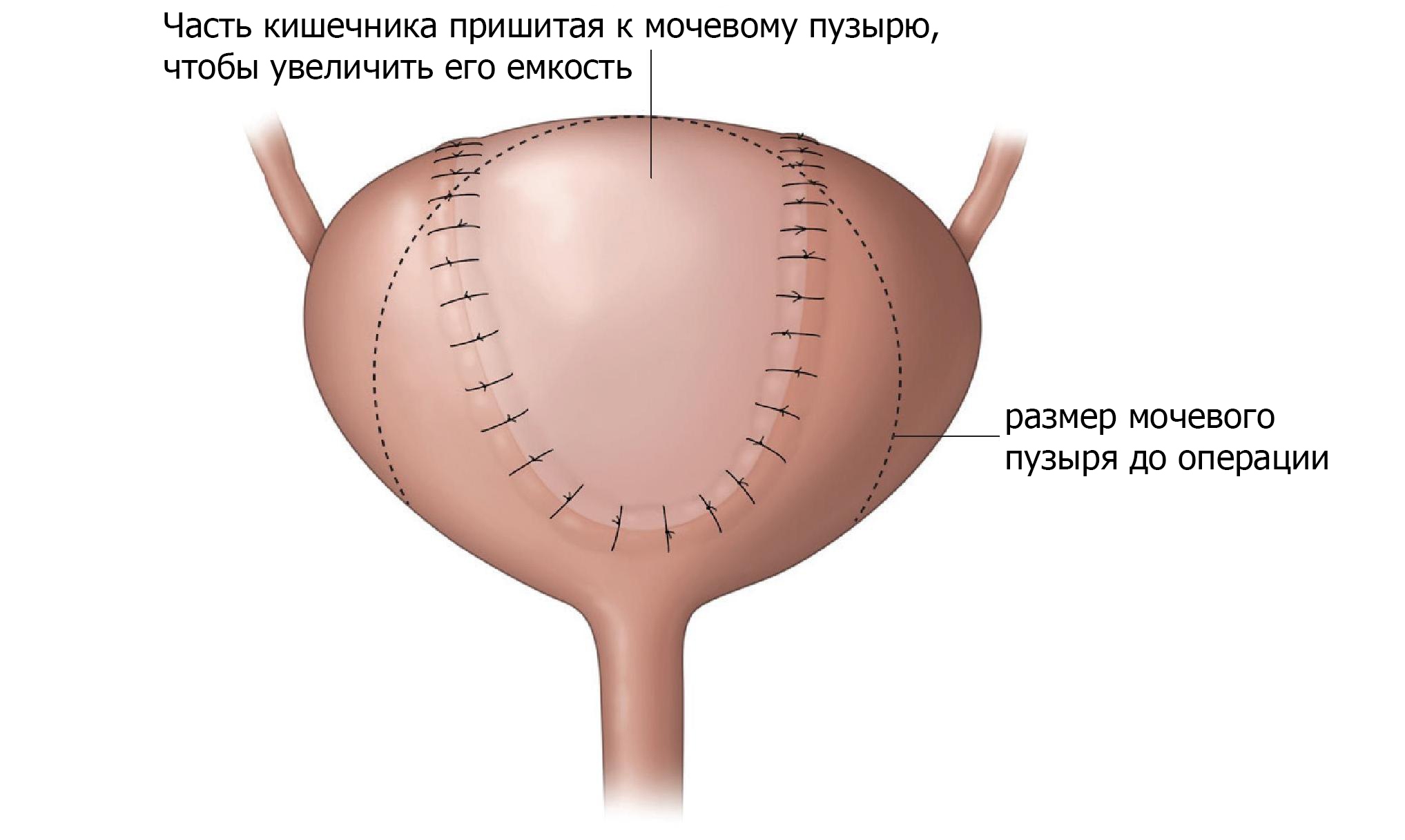 Операция на мочевом пузыре для увеличения его емкости