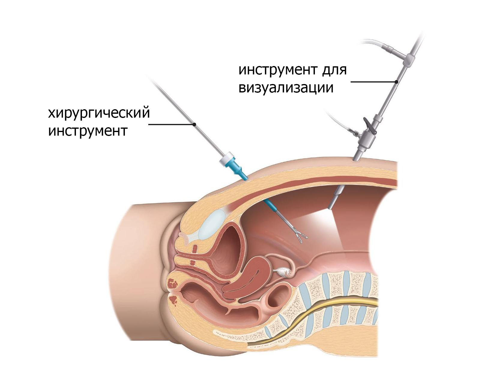 В лапароскопической хирургии вводятся инструменты через небольшие порты в брюшной полости